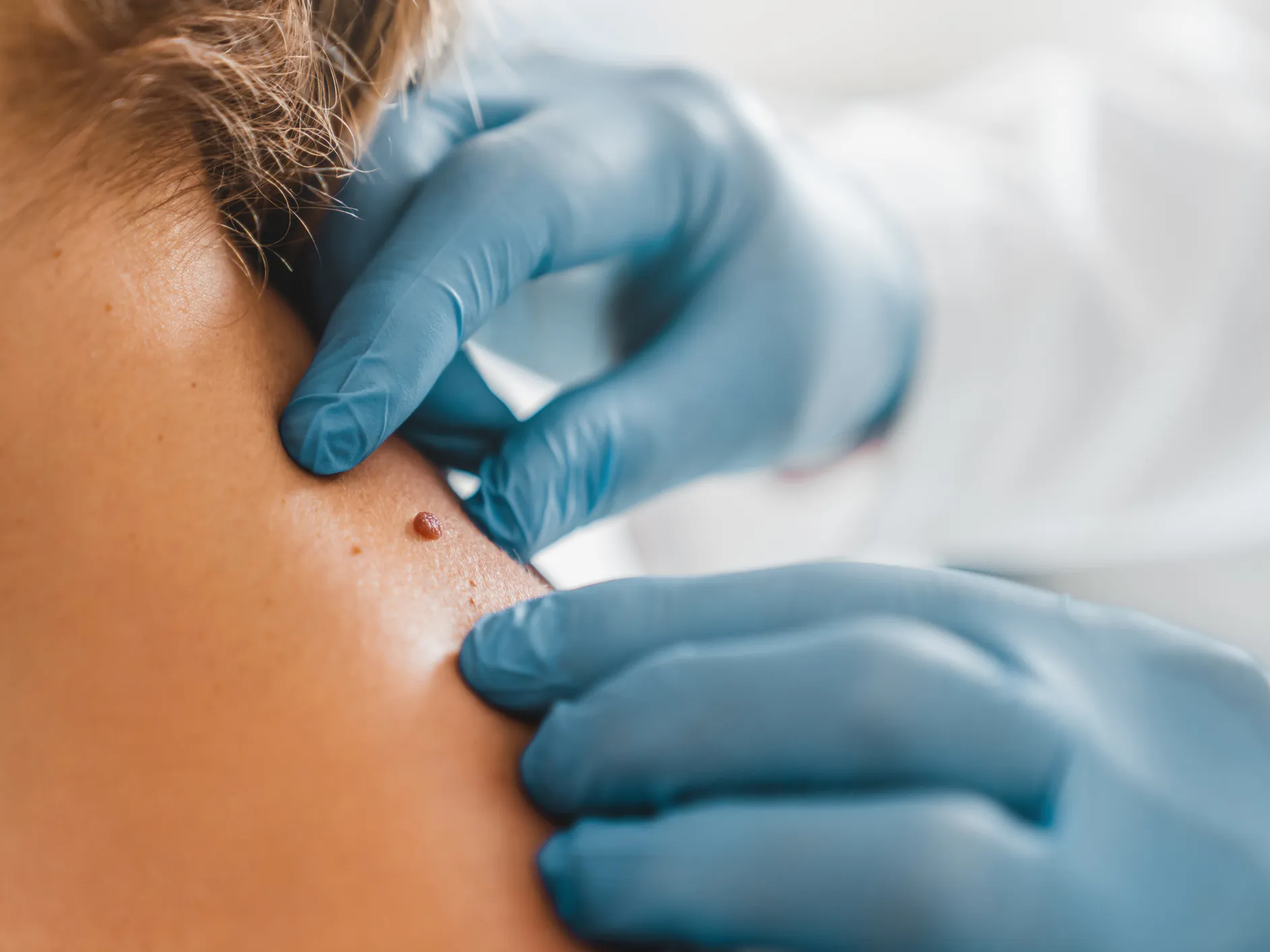 Skin Tag Removal £30